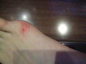 脚伤照片,运动损伤的警示与康复之道