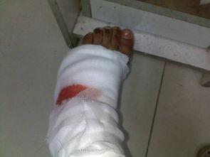 脚伤照片,运动损伤的警示与康复之道  第2张