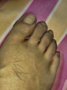 脚伤照片,运动损伤的警示与康复之道  第3张